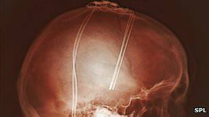 La técnica requiere implantar quirúrgicamente dos electrodos en el cerebro.